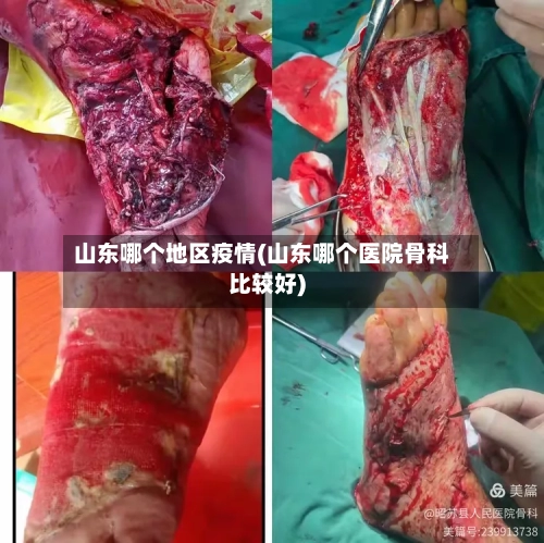 山东哪个地区疫情(山东哪个医院骨科比较好)