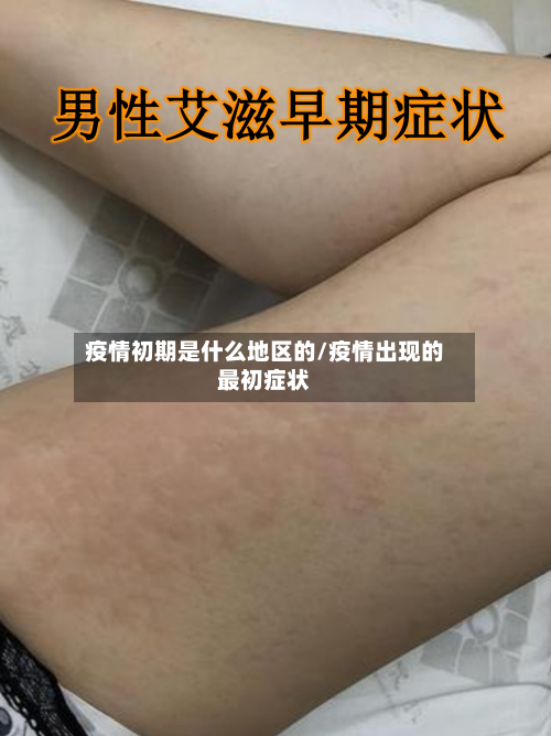 疫情初期是什么地区的/疫情出现的最初症状